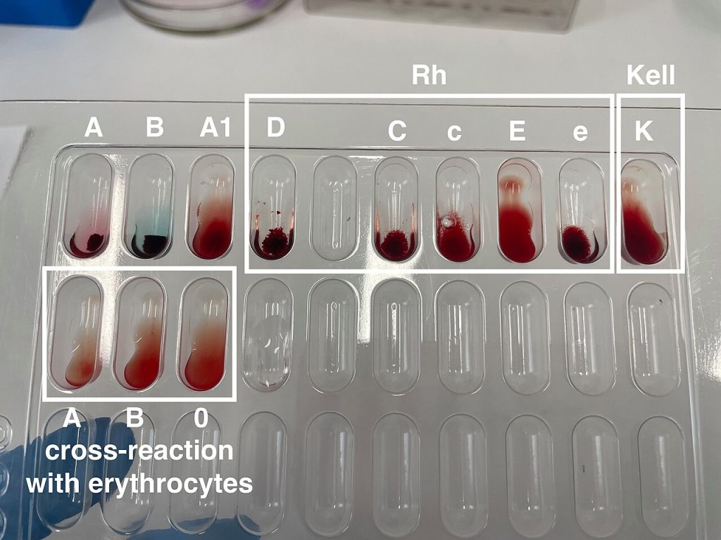 Blood Test Breakthrough Could Flag Crohn’s and Colitis 10 Years Before Diagnosis A blood group typing card with blood samples in a laboratory